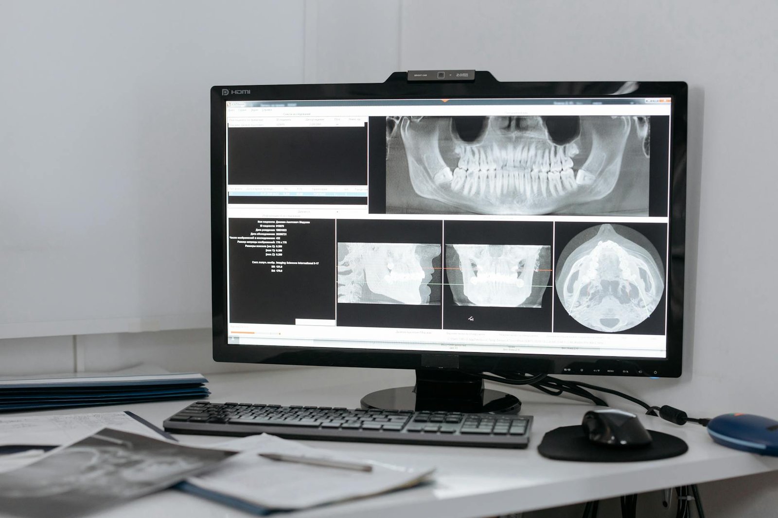 Understanding CBCT Technology in Third Molar Assessment