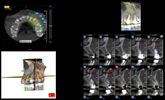 BONE ASSESSMENT & MEASURMENT