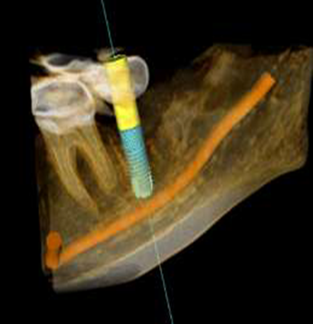 IMPLANT PLANNING