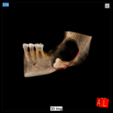 IMPACTED TEETH