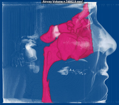 Airway Analysis